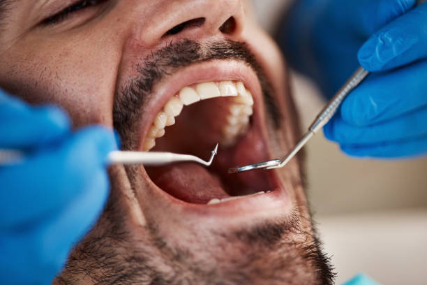 Best Emergency Dentist for Lost Fillings or Crowns in Centerville, TN